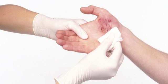 Первая помощь при кровотечениях