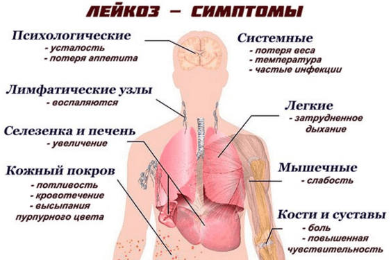 Анализ крови при лейкозе у взрослых и детей: как определить по показателям, признаки