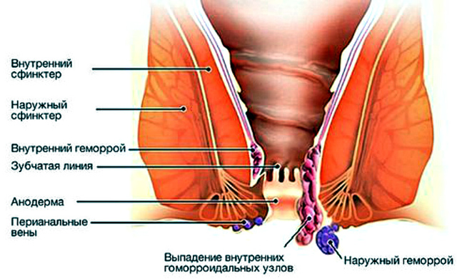 Геморрой у детей: причины, симптомы и лечение