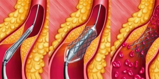 Лечится ли атеросклероз сосудов головного мозга - Про холестерин