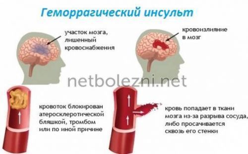 Инсульт левая или правая сторона, последствия, сколько живут