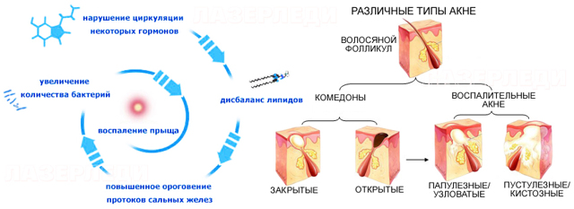 Прыщи (акне) у человека – причины и лечение
