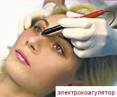 Удаление гемангиомы лазером у детей и взрослых: как проходит, отзывы и цена