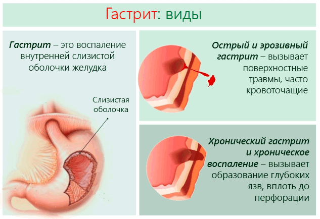 Болит грудь сбоку: причины и симптомы