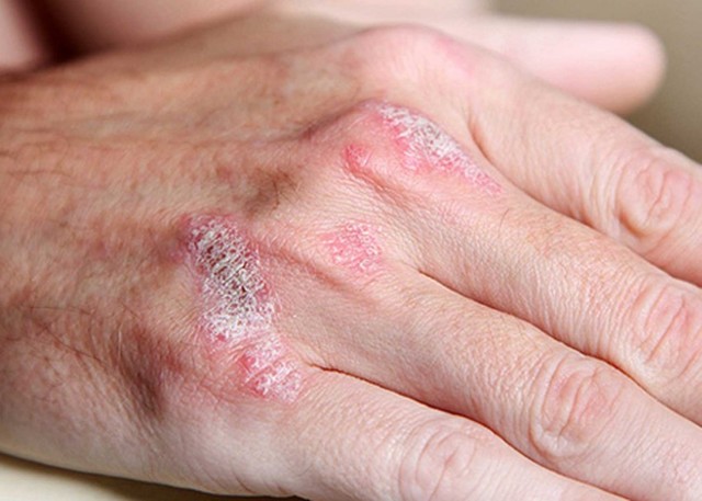 Лечение псориаз на руках - фото, симптомы, виды псориаза на руках