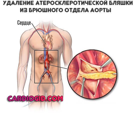 Как лечить высокое пульсовое давление. Пульсовое давление.