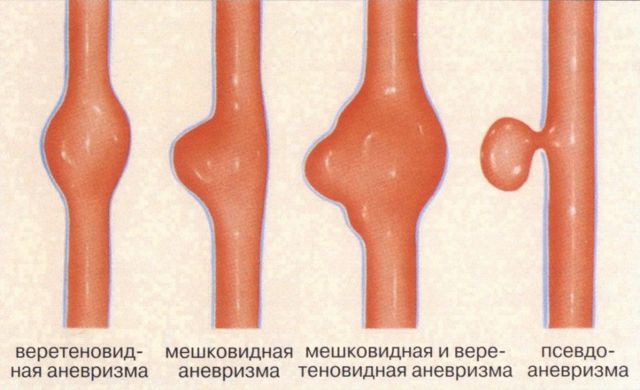 Аневризма бедренной артерии симптомы