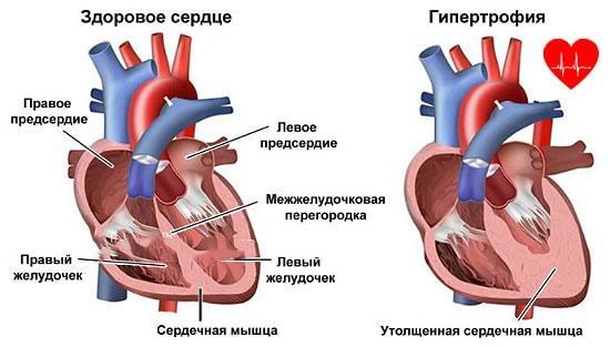 Утолщение стенок сердца - Все про гипертонию