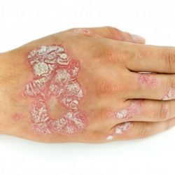 Лечение псориаз на руках - фото, симптомы, виды псориаза на руках