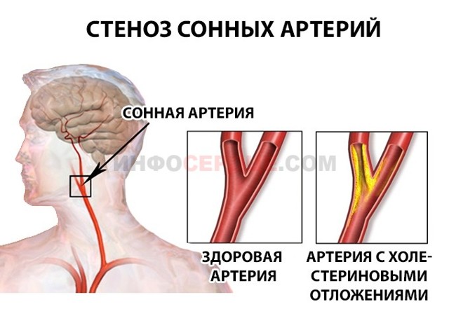 Атеросклеротические стенозы сонных артерий как причина мозгового инсульта - Сибирский медицинский портал