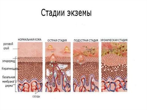 Экзема - причины, симптомы, диагностика и лечение