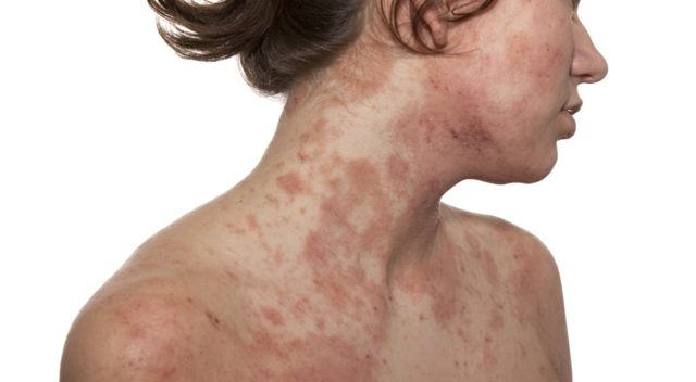 Дермовейт мазь и крем: инструкция по применению, отзывы, аналоги