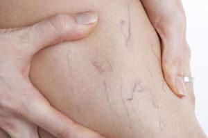 Болезни сосудов ног: причины появления и методы лечения