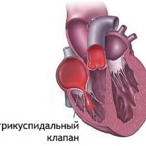 Регургитация трикуспидального клапана 1 степени