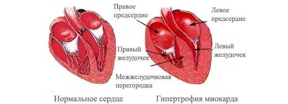 Кашель при сердечной недостаточности - Гипертонии нет
