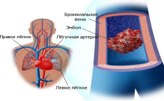 Эмболия: что это такое, ее виды и причины, диагностика, лечение