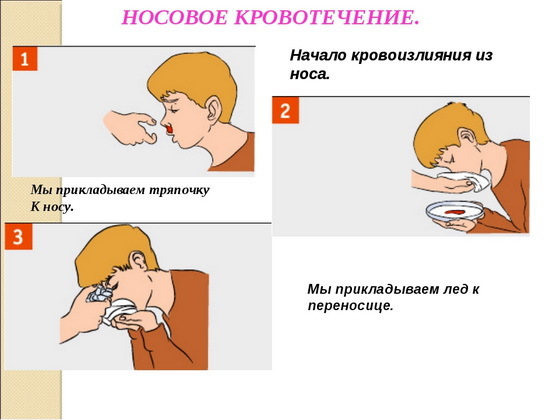 Причины носового кровотечения у ребенка. Как остановить кровь из носа