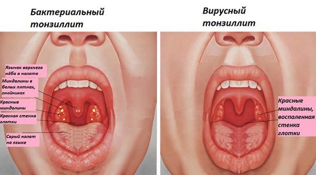 Тонзиллит: виды, фото, лечение и симптомы