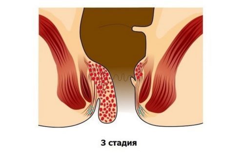 Геморрой у детей: причины, симптомы и лечение