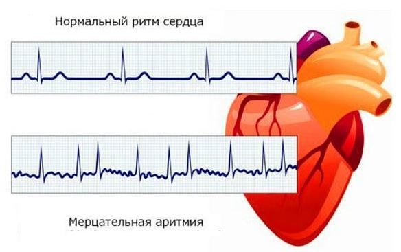 Как снять приступ аритмии в домашних условиях