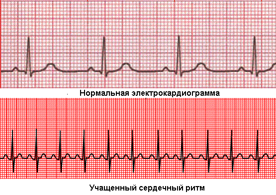 Повышенное сердцебиение, причины и лечение