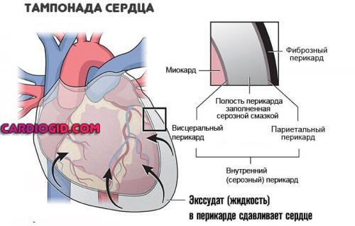 Ноющая боль в области сердца: причины и лечение