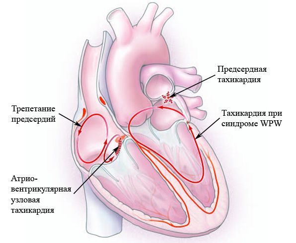 Тахикардия - причины, признаки, симптомы и лечение