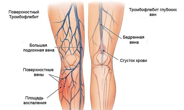 Тромбоз глубоких вен нижних конечностей лечение народными средствами