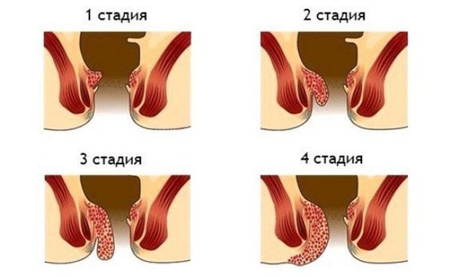 Хронический геморрой – лечение хронического геморроя, симптомы и признаки
