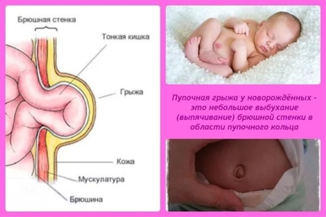 Пупочная грыжа у детей: фото, лечение и симптомы у детей