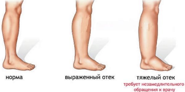 Отеки ног, рук и лица при беременности – что делать, как избавиться?