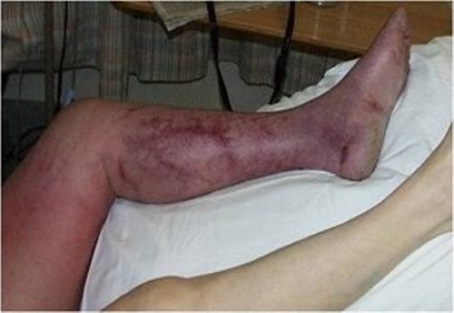 Непроходимость сосудов нижних конечностей - причины развития и лечение