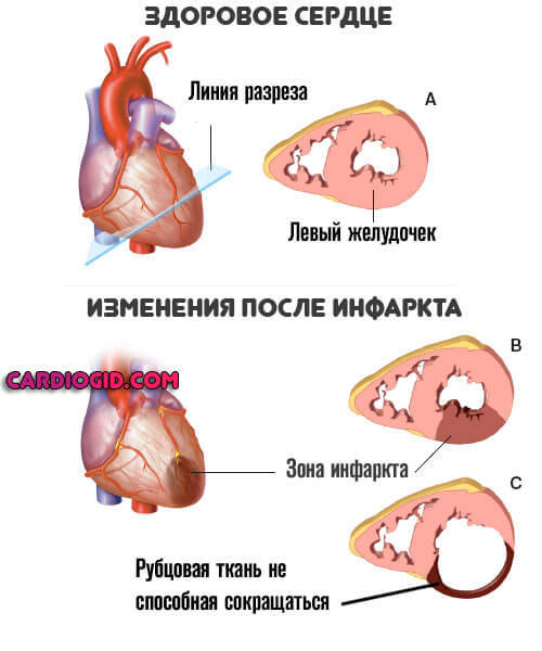 Милдронат - применение, инструкция, показания