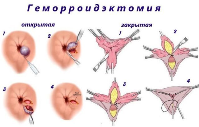 Что такое геморроидэктомия, послеоперационный период