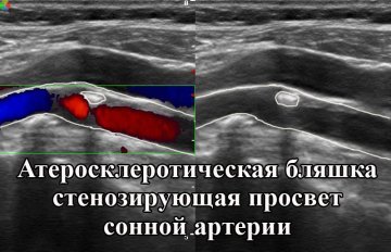 УЗДГ БЦА: что это такое, показания, проведение, расшифровка результатов