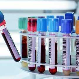 Лимфоциты повышены у взрослого, о чем это говорит? Причины повышенных лимфоцитов у взрослых