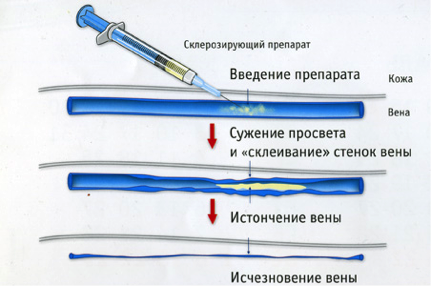 Склеротерапия вен нижних конечностей