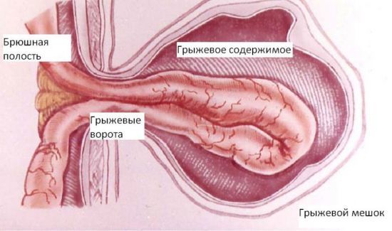 Грыжа белой линии живота - причины, симптомы, диагностика и лечение