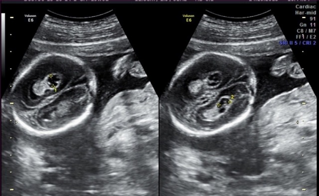 Киста сосудистого сплетения головного мозга: возникновение, диагностика, лечение. Опасна ли киста сосудистого сплетения для новорожденного?