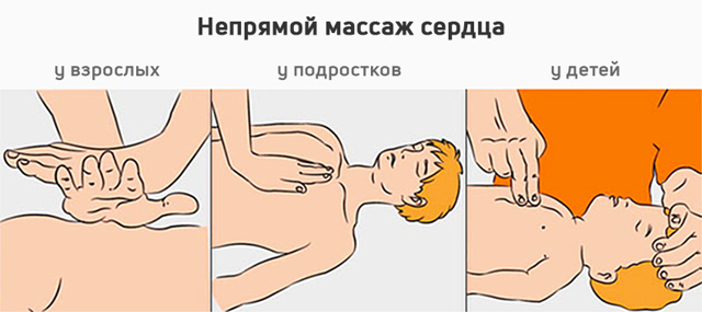 Что такое Непрямой массаж сердца?