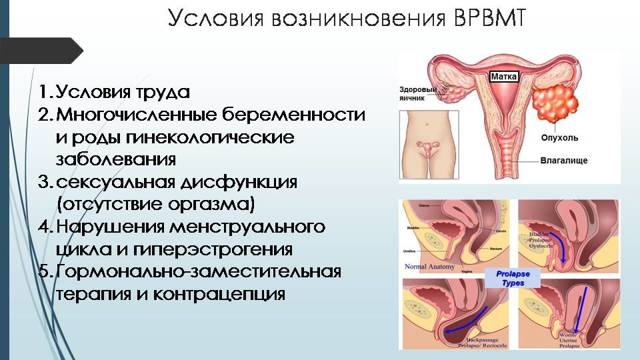 Варикоз вен малого таза у женщин: фото, симптомы и лечение
