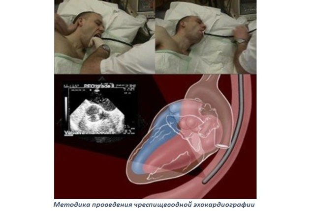 Сердечный кашель: симптомы, лечение