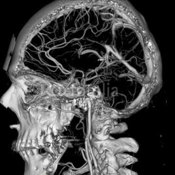Ангиография (МРА) головного мозга. Личный опыт