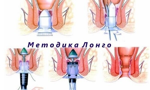 Лечение внутреннего геморроя