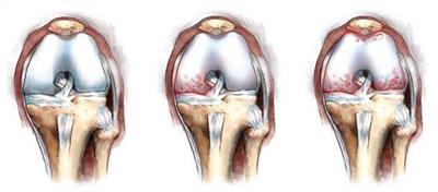 Системная склеродермия - диагностика, лечение, прогноз