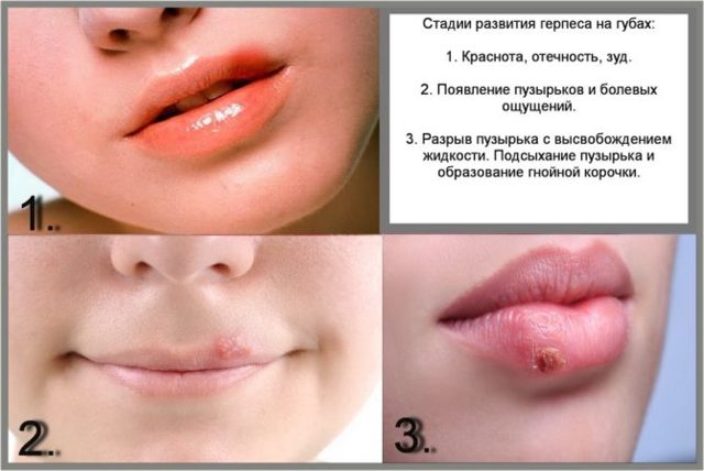 Герпес на губах - причины, признаки, симптомы, лечение