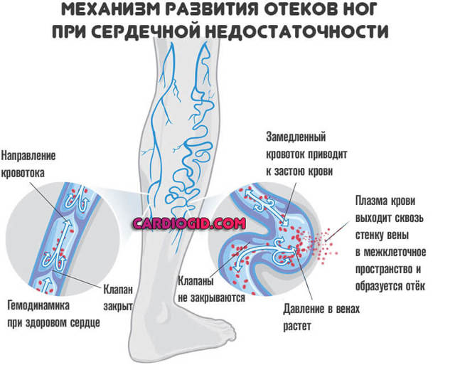 Отеки при сердечной недостаточности - патогенез, симптомы и лечение