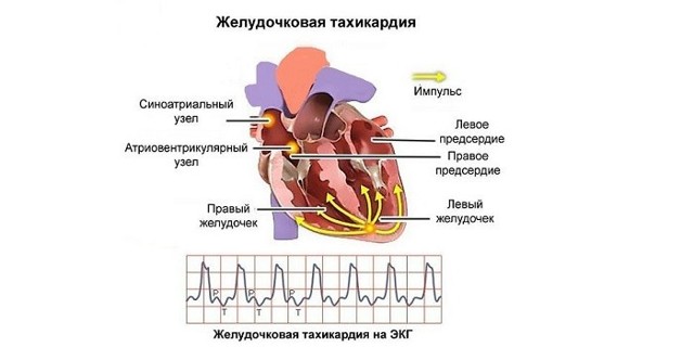 Тахикардия сердца: симптомы, диагностика и лечение - DELFI