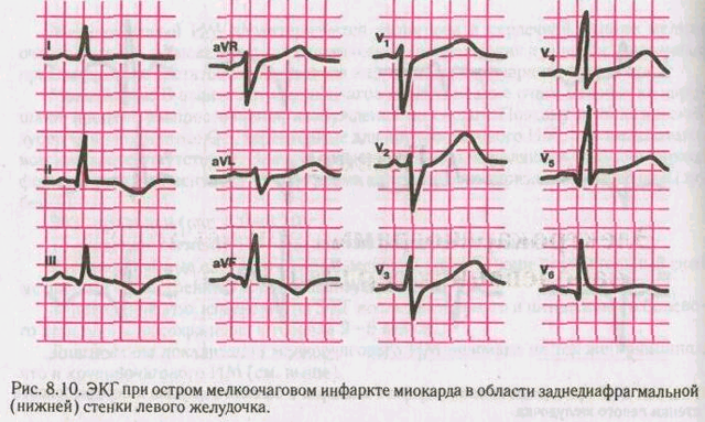 Инфаркт миокарда на ЭКГ: признаки, расшифровка