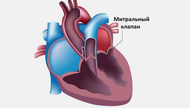 ПМК 1 степени - симптомы, лечение, диагностика